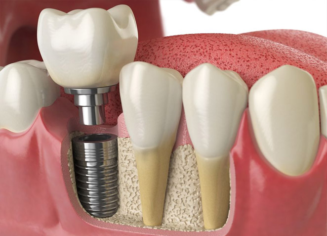 Dental Implants | Gregory Dental Care | Lubbock, TX