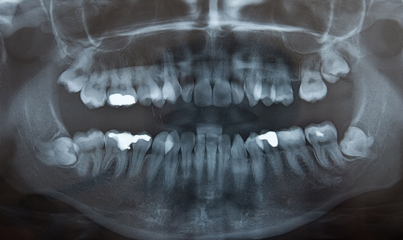 Dental X-Ray | Gregory Dental Care | Lubbock, TX